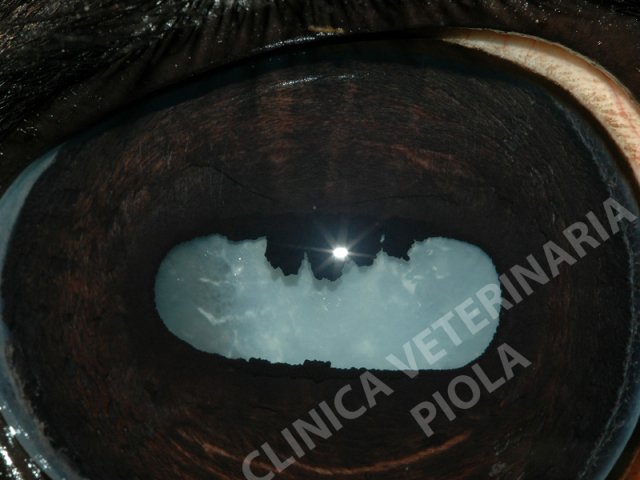 Cataratta matura primaria